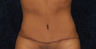 Tummy Tuck