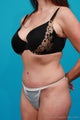 Tummy Tuck