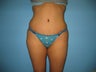 tummy tuck