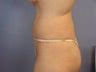 Tummy Tuck