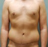 Abdominoplasty