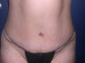 Tummy Tuck