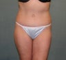 Tummy Tuck