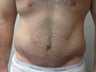 Abdominoplasty on 24 year old man