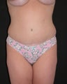 Tummy Tuck