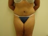 Tummy Tuck