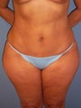 Tummy  Tuck