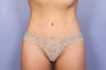 Tummy Tuck
