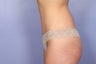 Tummy Tuck