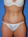Abdominoplasty 