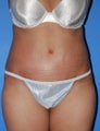 Tummy Tuck