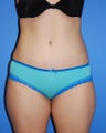 Tummy Tuck