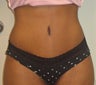 Tummy Tuck