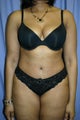 Tummy Tuck