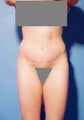 Abdominoplasty