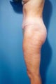 Abdominoplasty