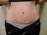 Tummy Tuck