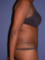 Tummy Tuck