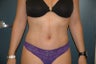 Tummy tuck
