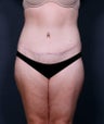 Tummy Tuck