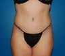 Tummy Tuck