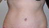 Abdominoplasty 