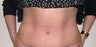 Abdominoplasty/Tummy Tuck 