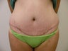 Abdominoplasty/Tummy Tuck 