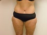 Abdominoplasty/Tummy Tuck 