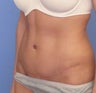 Abdominoplasty