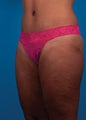 Abdominoplasty 