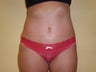 Tummy Tuck