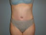 Tummy Tuck