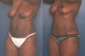 Full tummy tuck and Breast Lift