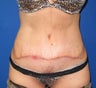 Abdominoplasty (Tummy Tuck) plus Liposuction