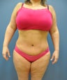 Tummy Tuck