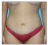 Tummy Tuck- Abdominoplasty
