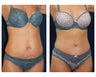 Abdominoplasty - Tummy Tuck