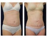 Abdominoplasty - Tummy Tuck