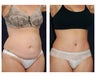 Abdominoplasty - Tummy Tuck