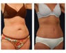 Abdominoplasty - Tummy Tuck