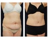 Abdominoplasty - Tummy Tuck
