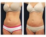 Abdominoplasty - Tummy Tuck
