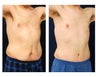 Abdominoplasty - Tummy Tuck