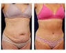 Abdominoplasty - Tummy Tuck