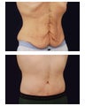 Abdominoplasty - Tummy Tuck