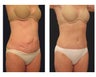 Abdominoplasty - Tummy Tuck