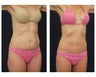 Abdominoplasty - Tummy Tuck