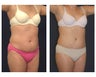 Abdominoplasty - Tummy Tuck