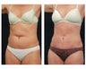 Abdominoplasty - Tummy Tuck